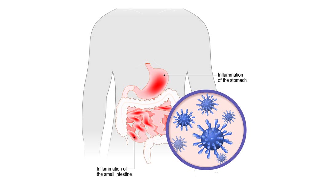 gastroenteritis-food-safety